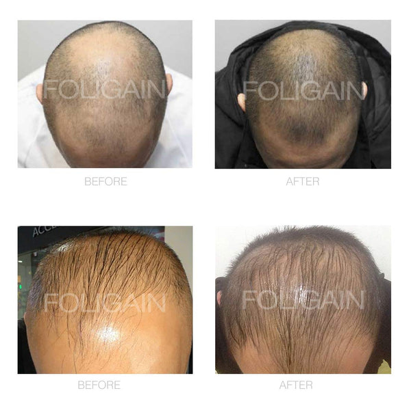 FOLIGAIN Minoxidil 5% Hair Regrowth Treatment For Men 6 Month Supply - FOLIGAIN EU